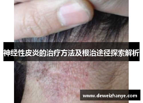 神经性皮炎的治疗方法及根治途径探索解析